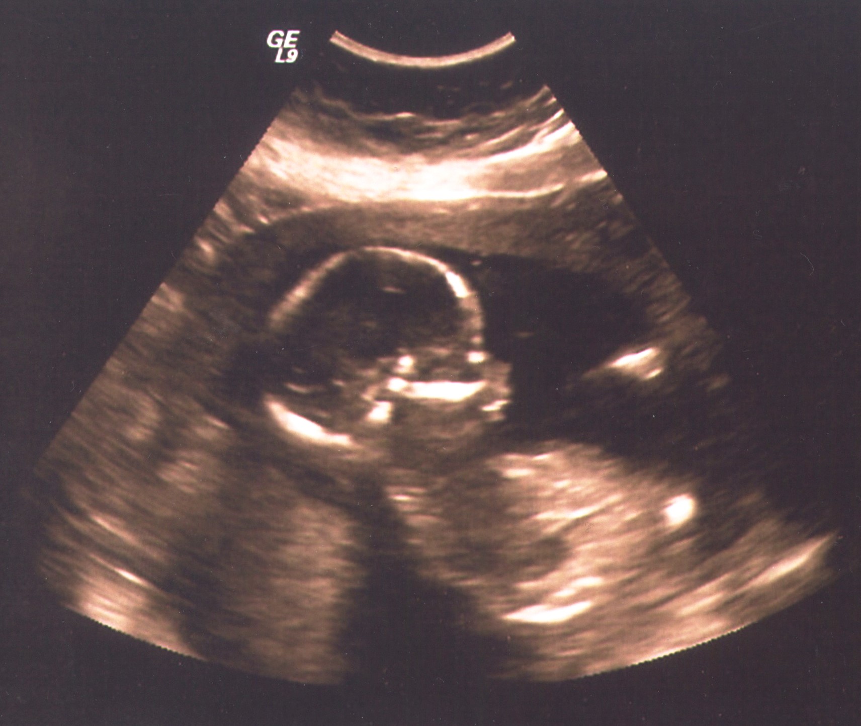 Sonogram Image